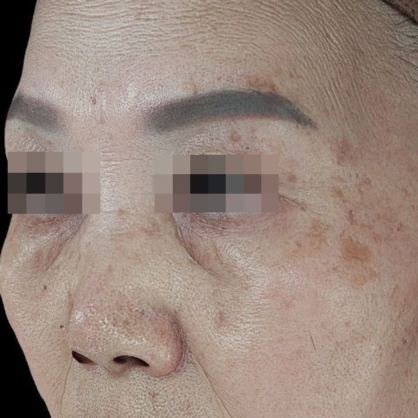 베이직색소 + 흑자제거 시술 전
