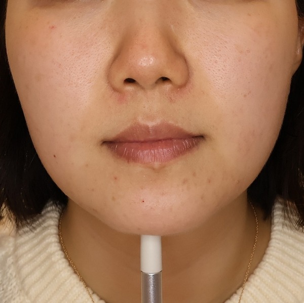 온다 60KJ 3 회 시술 전