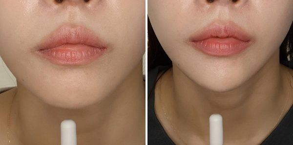 턱필러 전후