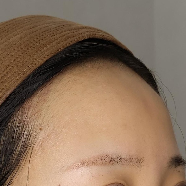 이마필러 시술 전