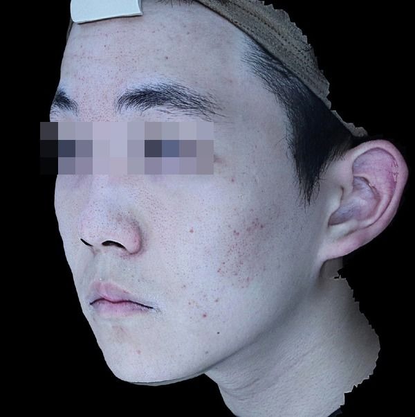 스탠다드 여드름 시술 후