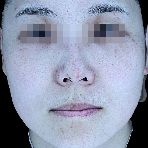 잡티제거 3회 + 흑자제거 시술 후