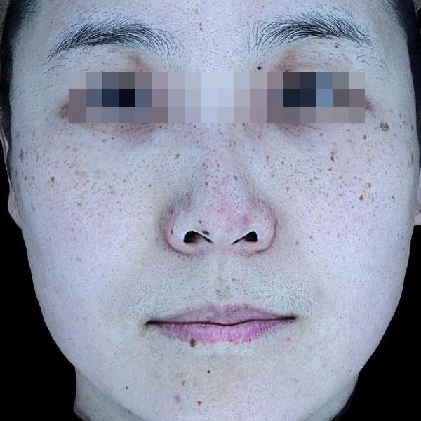 잡티제거 3회 + 흑자제거 시술 전