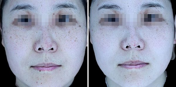 잡티제거 3회 + 흑자제거 전후