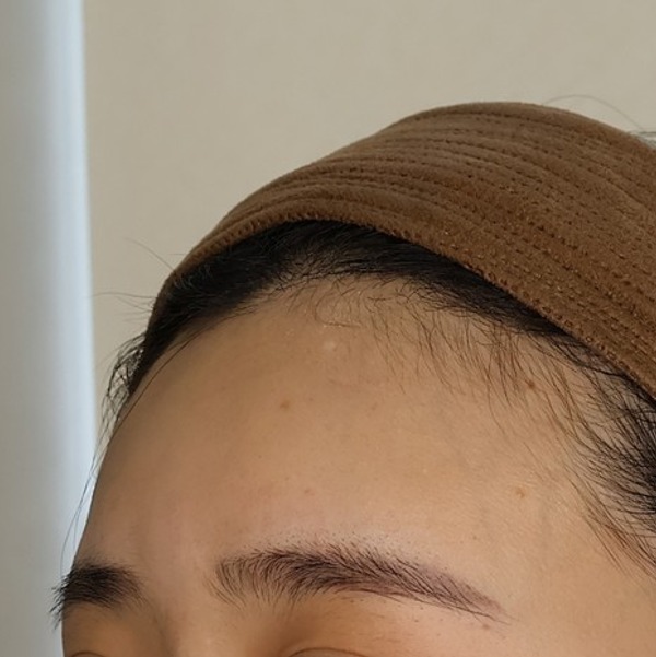 이마필러 시술 후