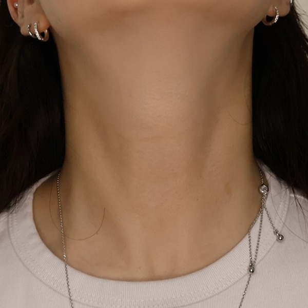 목주름필러 시술 후