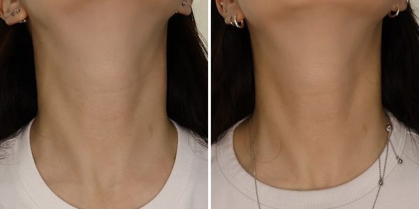 목주름필러 전후