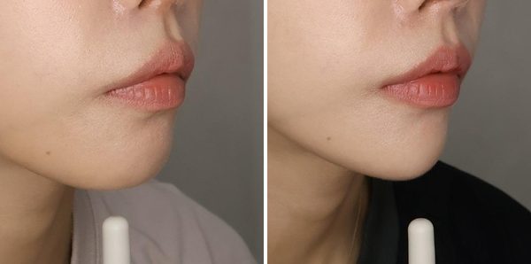 턱필러 전후
